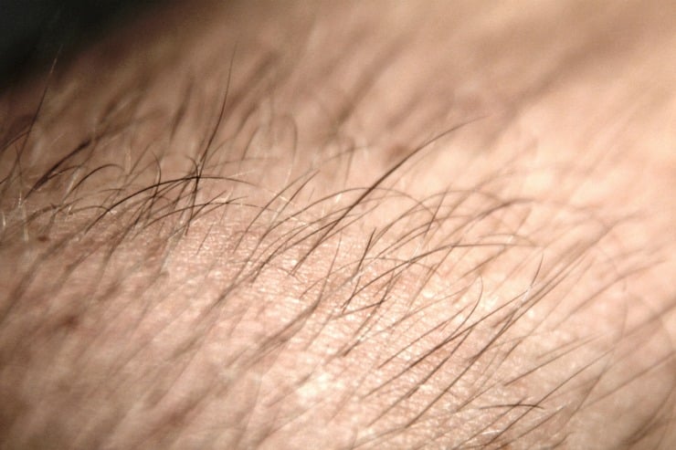 Hair Transplant