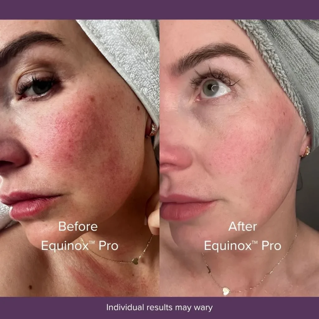 Equinox Pro Effective Before After